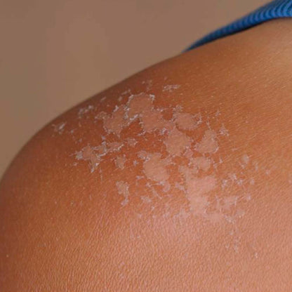 Jabón Natural De Caléndula (90g) - Calma La Piel Seca, Con Dermatitis E Irritaciones - Cicatriza Y Alivia Quemaduras_3