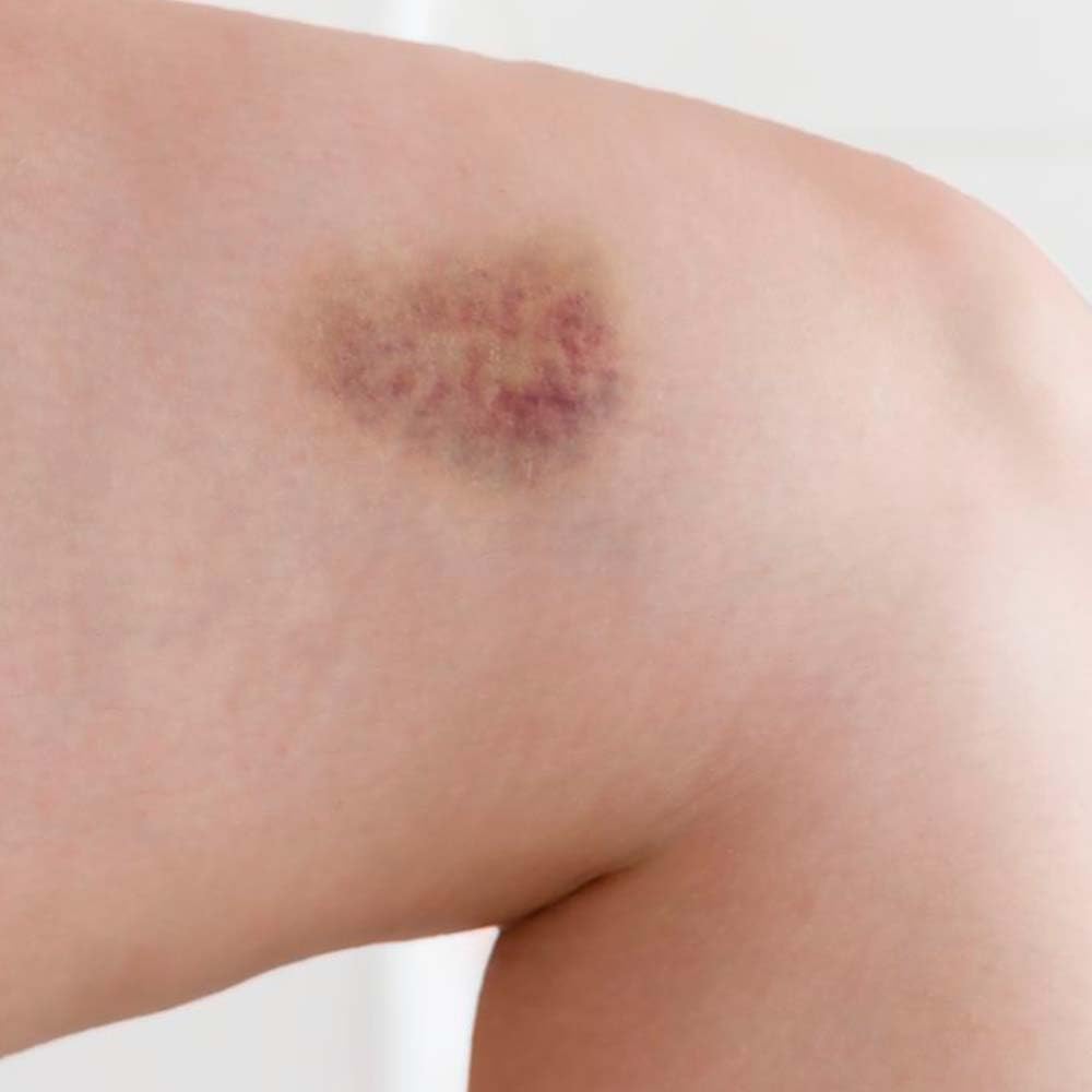Pack 10 Jabón Natural De Árnica - Mejora Las Varices Y Hematomas - Alivia Las Piernas Cansadas - Cara Y Cuerpo_5