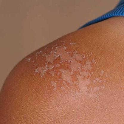 Pack 2 Jabón Natural De Caléndula - Calma La Piel Seca, Con Dermatitis E Irritaciones - Cicatriza Y Alivia Quemaduras_3